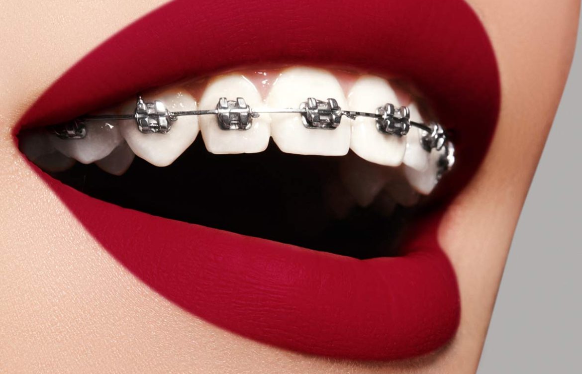 Affordable Braces in Dubai: Straighten Your Smile