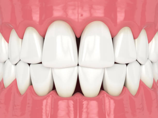 dental bonding front teeth gap