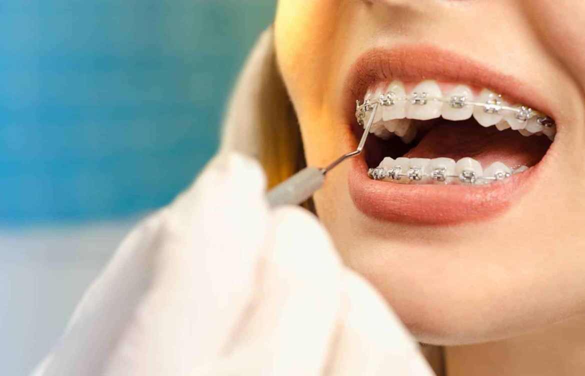 What Every Patient Should Understand Before Getting Braces